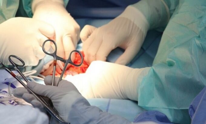 Ligamentotomia - zakila handitzeko kirurgia